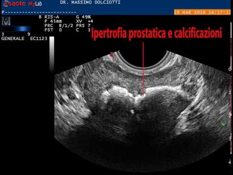 Calcificazioni prostatiche: un campanello d’allarme per il rischio di salute